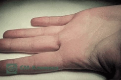 Гигрома пальцев рук — СПБ ГБУЗ «Кожно-венерологический диспансер № 4»