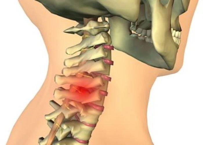 «Шейный остеохондроз» — дегенеративные изменения шейного отдела позвоночника