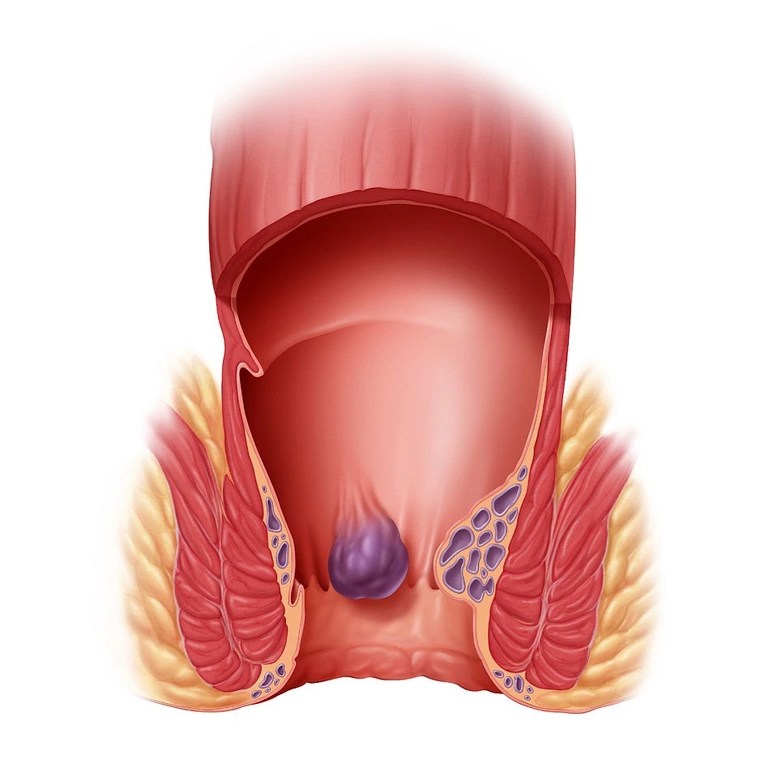 Чи є геморой ознакою раку анального каналу?