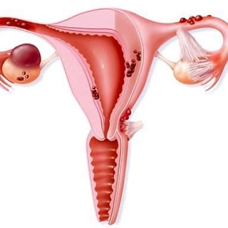 Чем лечить воспаление по женски: воспаление яичников, другие