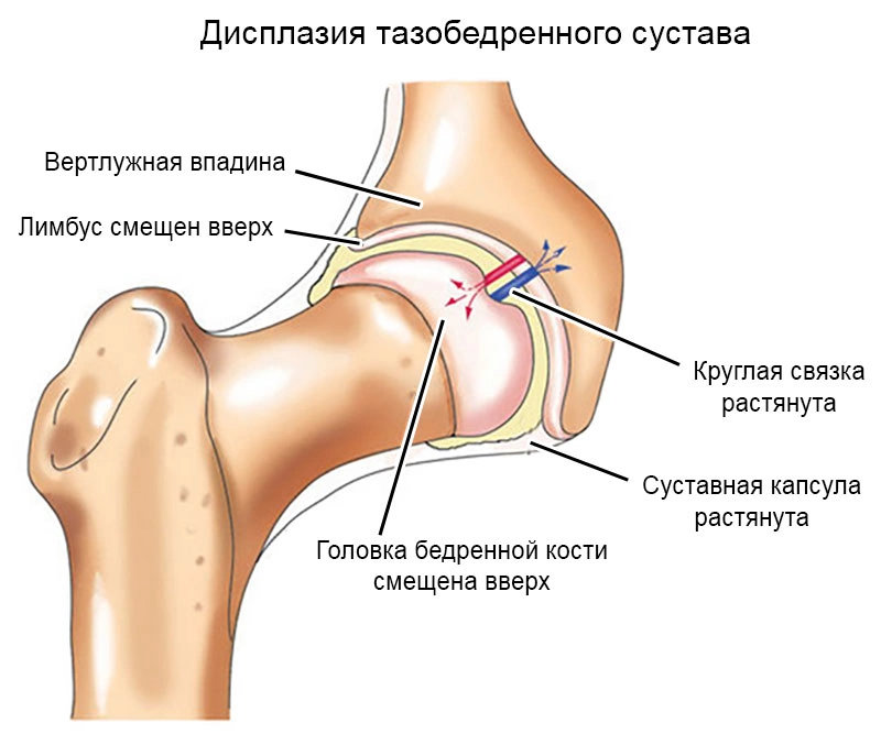 Лечение Дисплазия тазобедренного сустава и врожденный вывих бедра - Ортопедия Руслана Сергиенко