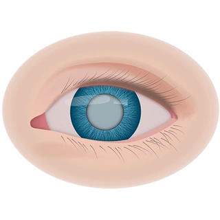 Как развивается катаракта: этапы, симптомы, лечение
