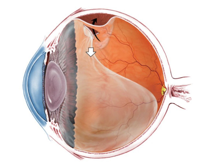 Отслоение сетчатки глаза: лечение, симптомы, причины, последствия и виды заболевания