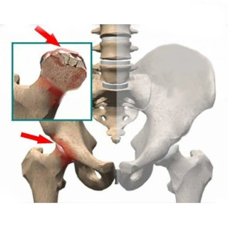 Асептический некроз кости: симптомы, причины, диагностика и лечение