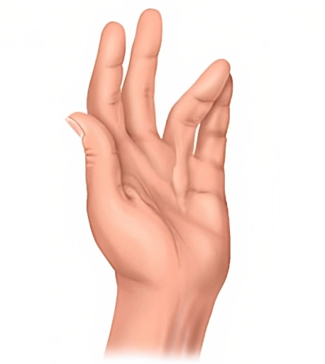 Kontraktura Loketn ho Kloubu Po Zlomenin L ba P iny P znaky Kontraktura Loketn ho Kloubu Po Zlomenin L ba P iny P znaky