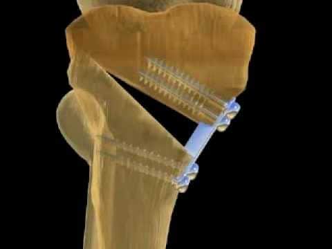 Остеотомия как частный случай остеопластики
