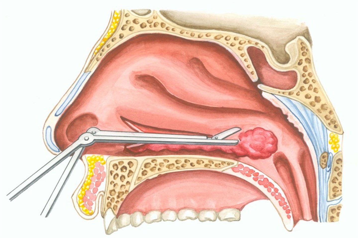 Операция вазотомия носа