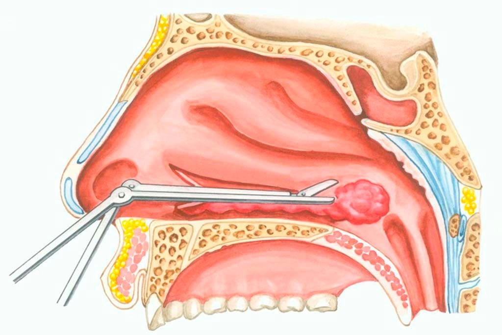 Вазотомия носа - операция при вазомоторном рините | Лазерная и  радиоволновая вазотомия носовых раковин